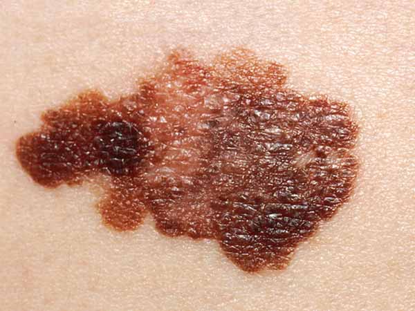 melanoma