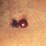 Melanoma amb tres parts