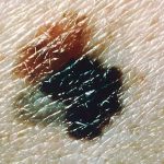 Melanoma negre i blau