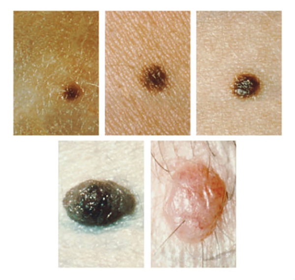 Més informació sobre l'article Una piga comuna pot convertir-se en melanoma?