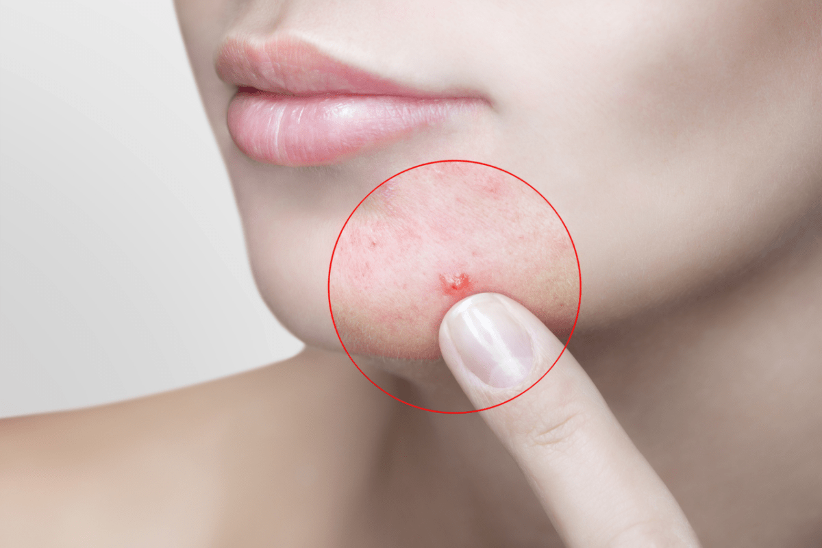 Més informació sobre l'article Acne. Aliments cal evitar a la dieta per a prevenir-lo