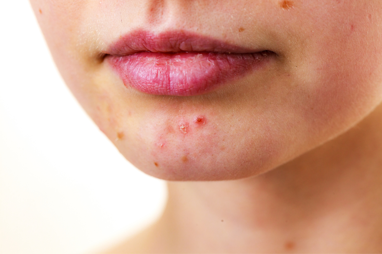 Més informació sobre l'article Tractaments per a eliminar les cicatrius d’acne