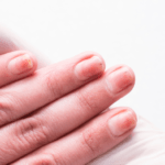 Com eliminar fongs de les ungles? Causes, tractaments i quan consultar el dermatòleg