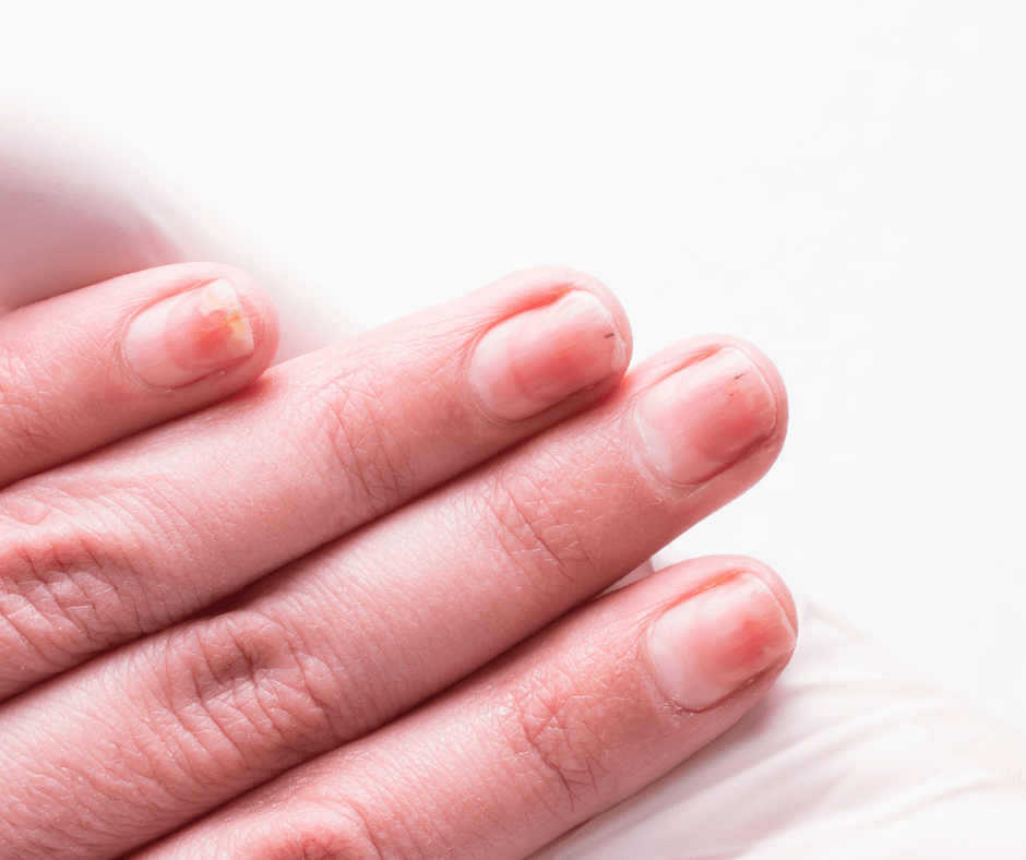 Read more about the article Malalties de les ungles: motius de consulta dermatològica