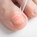 Fongs a les ungles, diagnòstic i tractament a Girona