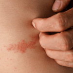 Infeccions a la pell: quines són les més comunes?
