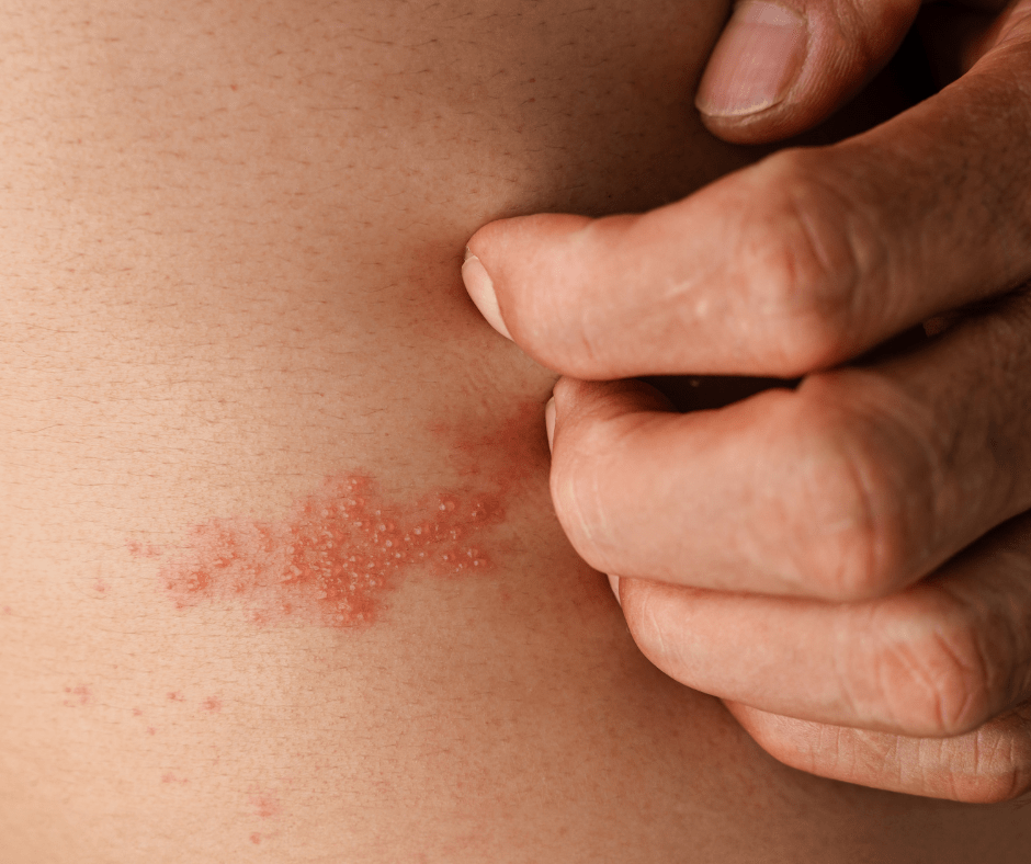 Més informació sobre l'article Infeccions a la pell: quines són les més comunes?