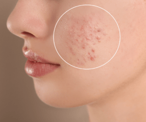 acne hormonal