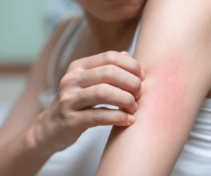 Més informació sobre l'article Quina relació hi ha entre l’alimentació i la dermatitis atòpica?