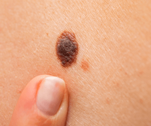 Més informació sobre l'article Quins són els símptomes del melanoma?