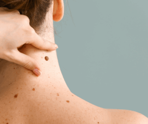 Més informació sobre l'article Com prevenir el melanoma cutani: consells clau per cuidar la teva pell