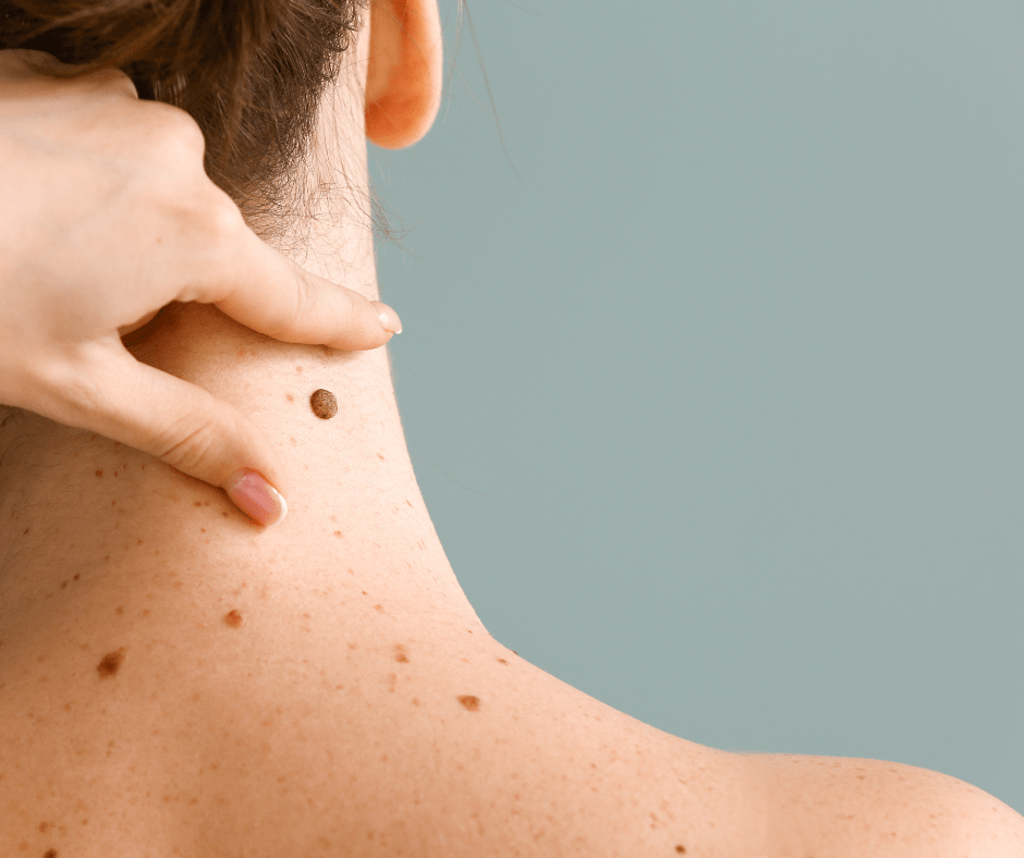 Més informació sobre l'article Com prevenir el melanoma cutani: consells clau per cuidar la teva pell