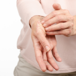 Psoriasi a l’hivern: Per què empitjora i com prevenir-la?