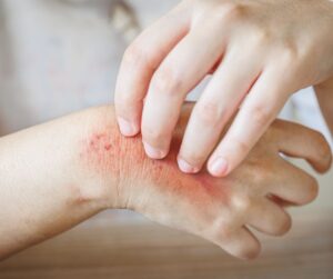 Dermatòleg especialista en fongs a Girona realitzant diagnòstic dermatològic de micosi cutània
