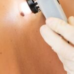 Piga comuna i melanoma: com distingir-les i quan consultar al dermatòleg