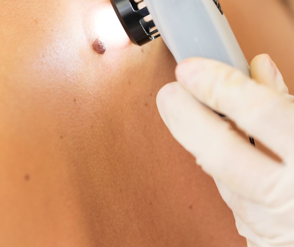 Més informació sobre l'article Piga comuna i melanoma: com distingir-les i quan consultar al dermatòleg