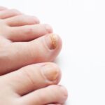 Malalties de les ungles: com identificar-les i quan consultar al dermatòleg