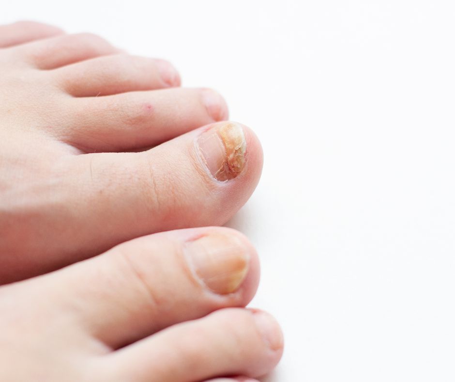 Més informació sobre l'article Malalties de les ungles: com identificar-les i quan consultar al dermatòleg