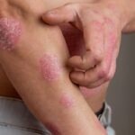 Psoriasi: símptomes, causes i quan anar al dermatòleg