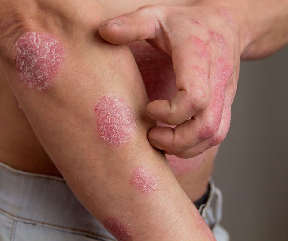 Més informació sobre l'article Psoriasi: símptomes, causes i quan anar al dermatòleg