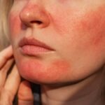 Rosàcia: símptomes, causes i tractament
