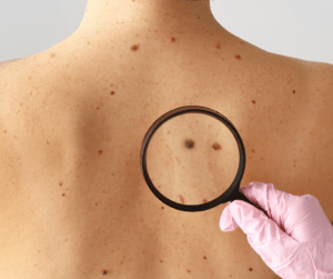 mètode ABCDE melanoma
